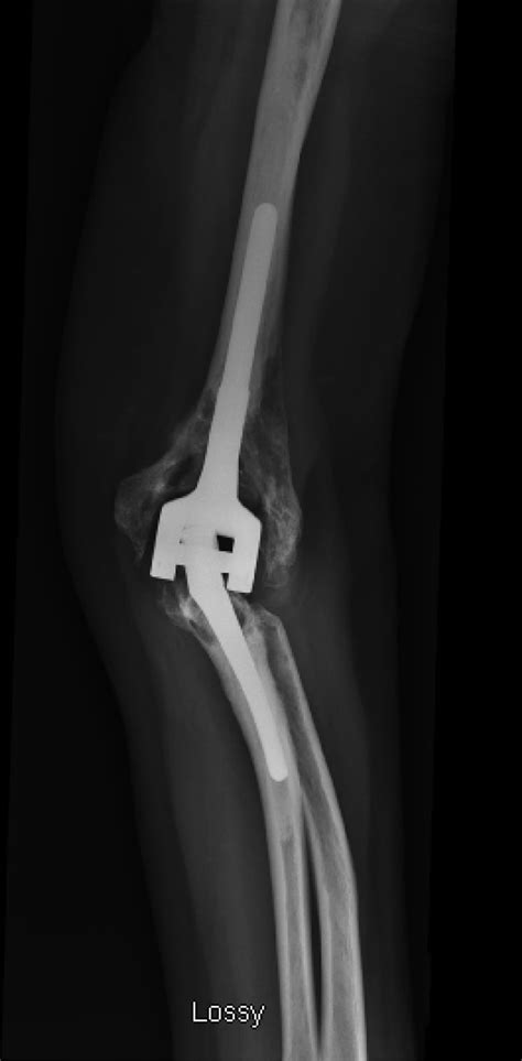 Outcomes Of Semiconstrained Total Elbow Arthroplasty Performed For