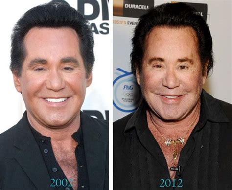 Pin By Brenda Biever On Celeb Beforeafters Celebrity Plastic Surgery