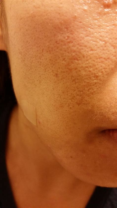 Skin Concerns Atrophic Acne Scarring Has Anyone Improved Icepick Or