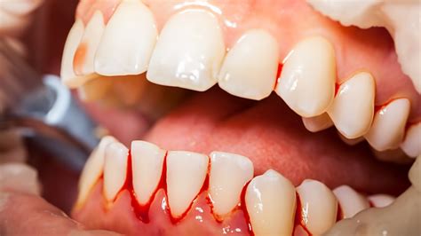 Bleeding Gums Causes Prevention And Treatment Scottsdale Cosmetic Dentistry Excellence
