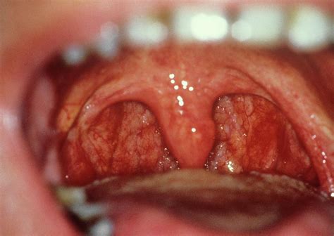 Healthy Tonsils