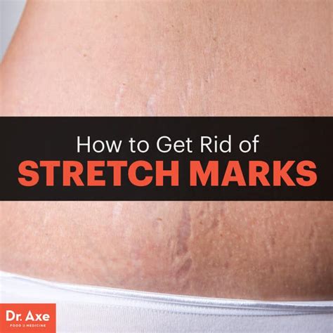 How To Get Rid Of Stretch Marks Dr Axe