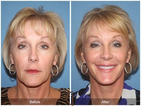 Irvine Mini Facelift Orange County Cosmetic Surgery