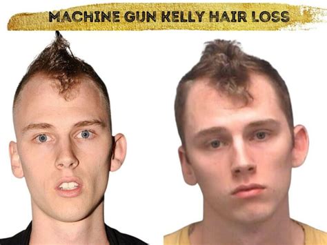 Machine Gun Kelly Mgk Hair Transplant Hair Loss Stages