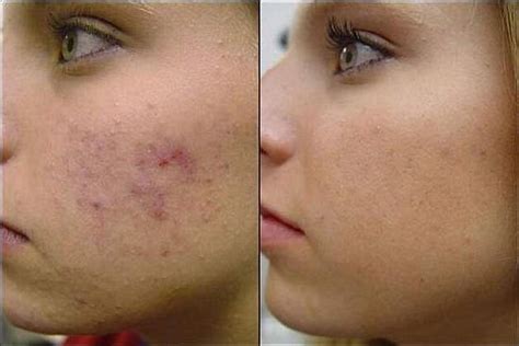 Simple Guide Treating Acne Scars Health Digest