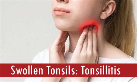 Swollen Tonsils Tonsillitis Causes And Treatments