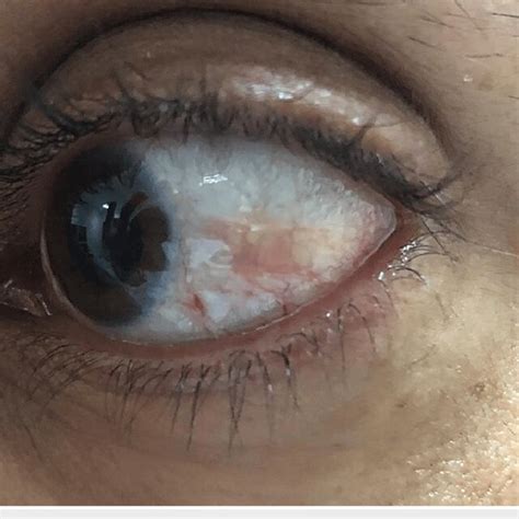 A Post Treatment Photograph Of The Patient With Nodular Episcleritis At