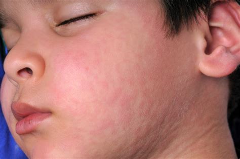 Toddler allergic skin reactionshow all. Skin Allergies | Tri-State Allergy