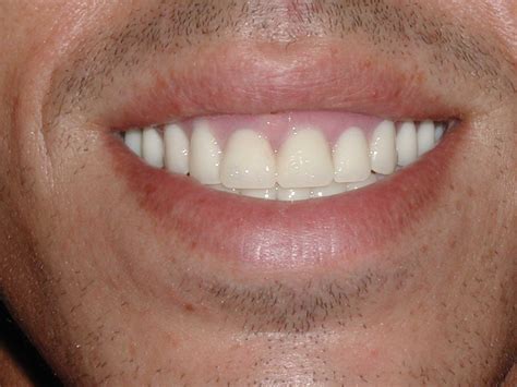 Immediate Denture After Picture Dr Caputo Palm Harbor Dentist