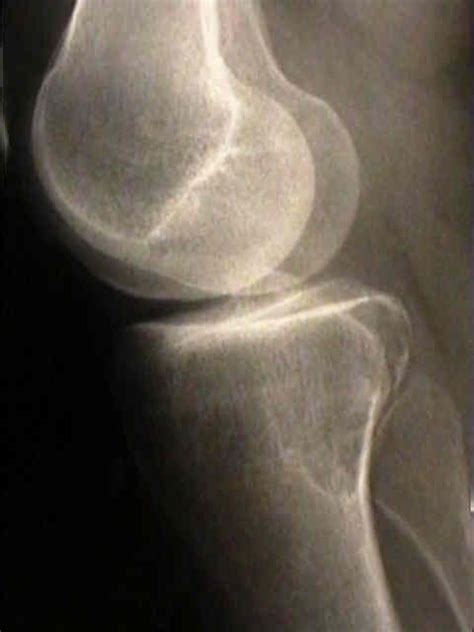 Giant-cell tumor of bone : Wheeless' Textbook of Orthopaedics