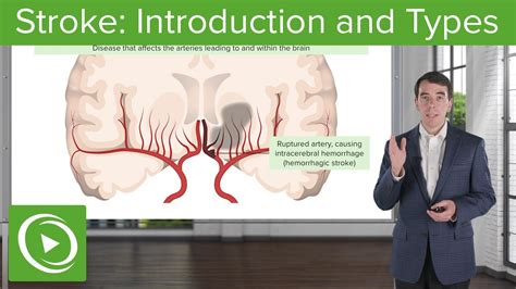 Stroke Introduction And Types Clinical Neurology Youtube