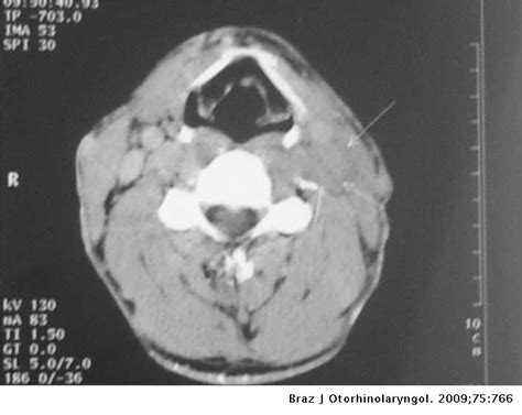 Neck Metastasis Of The Testicular Teratoma In An Adult A Case Report