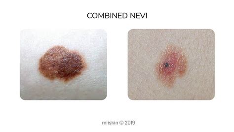 About Moles Types Warning Signs Causes And Prevention