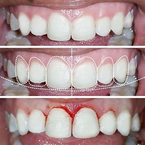 Cirugia Plastica De Encias Clinica Dental Krebs ® Lima Peru