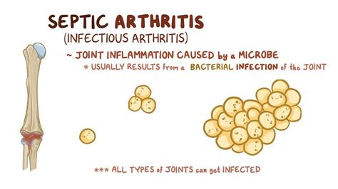 Septic Arthritis Osmosis