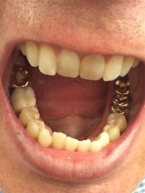 Where can i get gold teeth. Answer Man: Can gold teeth be pulled before cremation?
