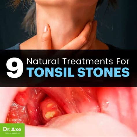 Symptoms Of Tonsil Stones My XXX Hot Girl