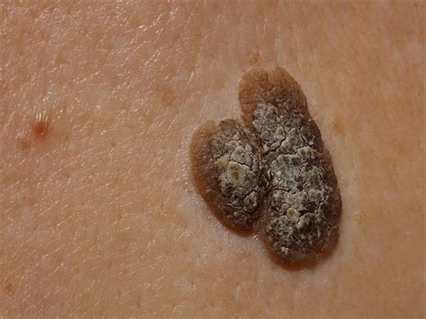 Seborrheic Keratoses What To Know About These Benign Skin Growths