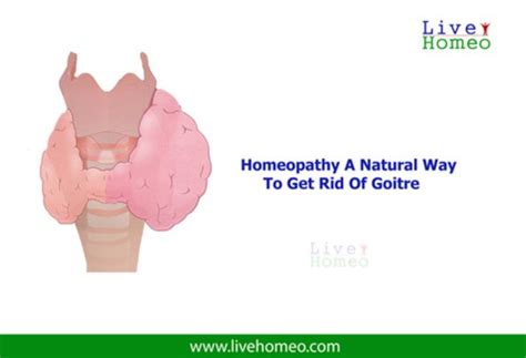 Home Homeopathy Treatment Homeopathy Enlarged Thyroid