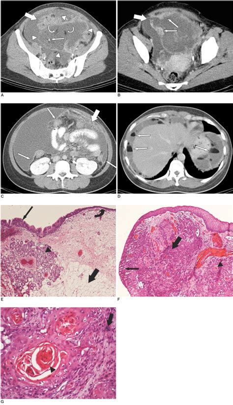 Malignant Transformation Of Mature Cystic Teratoma A Download