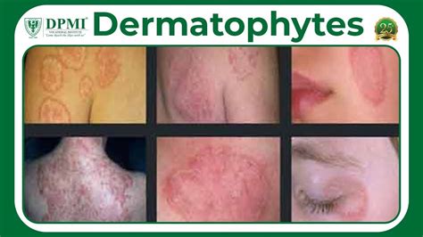 Dermatophyte Infection Types Of Dermatophytes Dermatophyte Symptoms