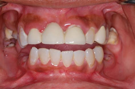 Full Mouth Treatment Gallery — Texas Dental Solutions