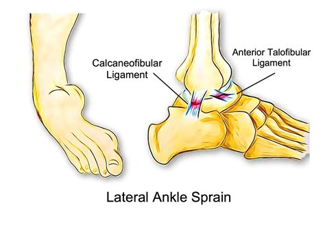 Can Poor Balance Lead To Ankle Sprains Beachbox Physiotherapy