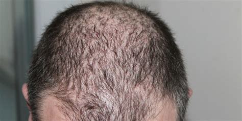 Dos And Donts Of Hair Loss And Male Pattern Baldness Treatments