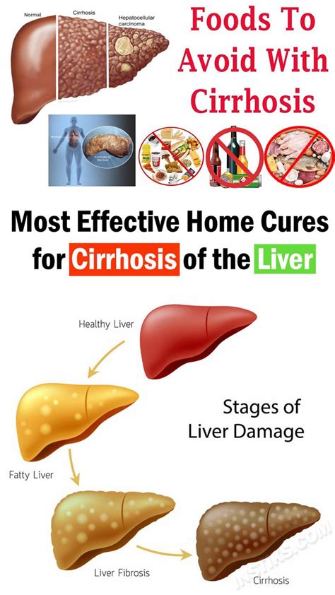 12 Home Remedies For Cirrhosis Of The Liver Liver Diet Fatty Liver