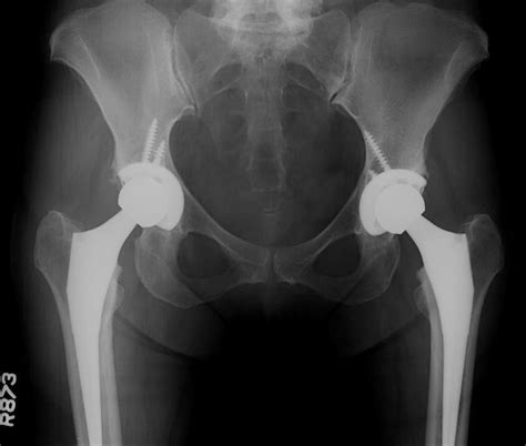 Total Hip Replacement In A Middle Aged Female Patient With Bilateral
