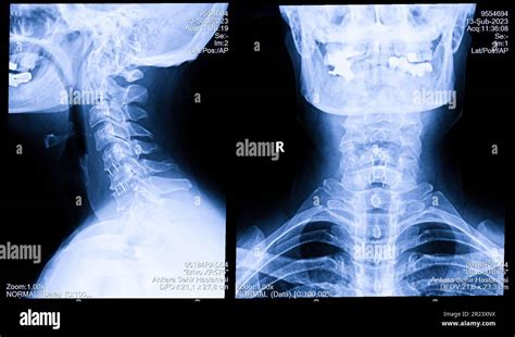 Womans Cervical Spine X Ray Human Neck Radiography Stock Photo Alamy