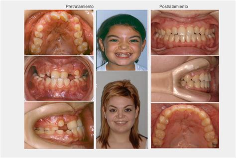 Dentición Permanente Clinica Martin Romero