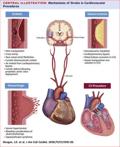 Cerebrovascular Events After Cardiovascular Procedures Risk Factors