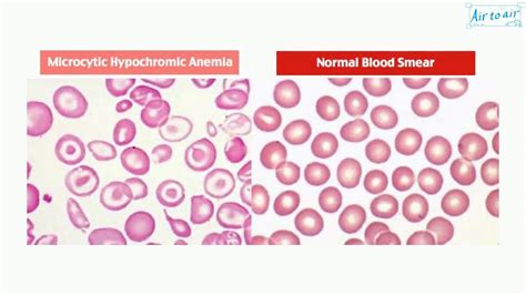 Microcytic Hypochromic Anemia Youtube