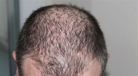 Male Hair Loss Pattern And Therapy