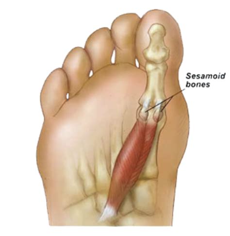 Sesamoiditis The Pain In The Foot Nobody Knows About