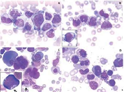 A B Peripheral Blood Smear Showing Presence Of Abnormal Monocytes