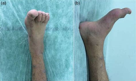 Open Dislocation Of Ankle Without Fracture Treated With An External