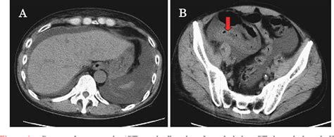 Figure 1 From A Case Of Iga Related Enteropathy Complicated With