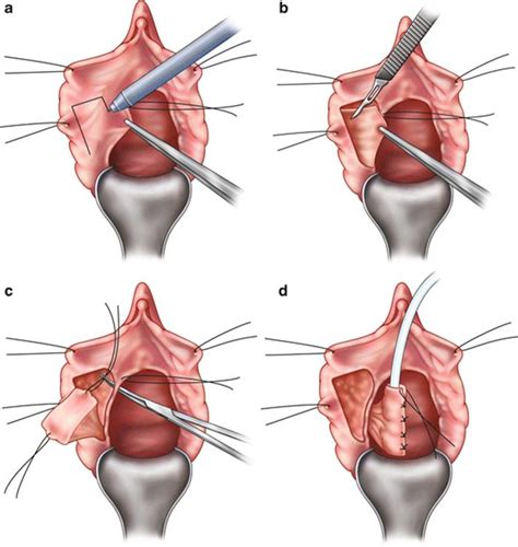 Urethroplasty For Female Urethral Stricture Female Pelvic Surgery Hot