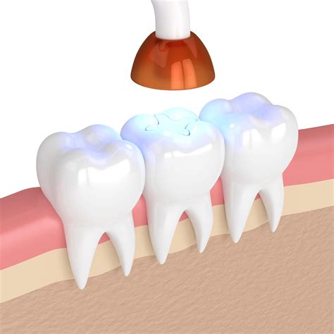 It can take awhile for the nerve to settle down but eventually it does. Fillings - Howard Family Dental