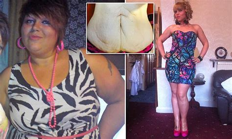 Mother Left With Huge Flap Of Saggy Skin After Losing 10st Begs The Nhs