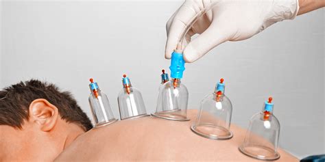 Here Are The Types Of Cupping Therapy Or Hijama Therapy