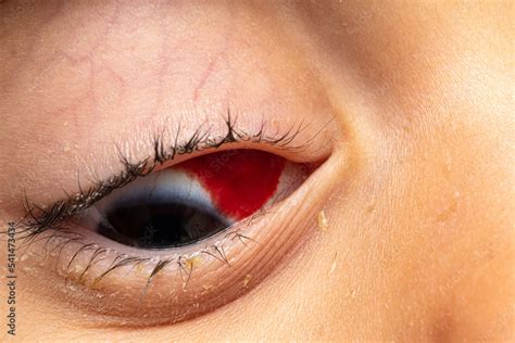 Subconjunctival Hemorrhage Macro Of Blood In A Childs Red Eye
