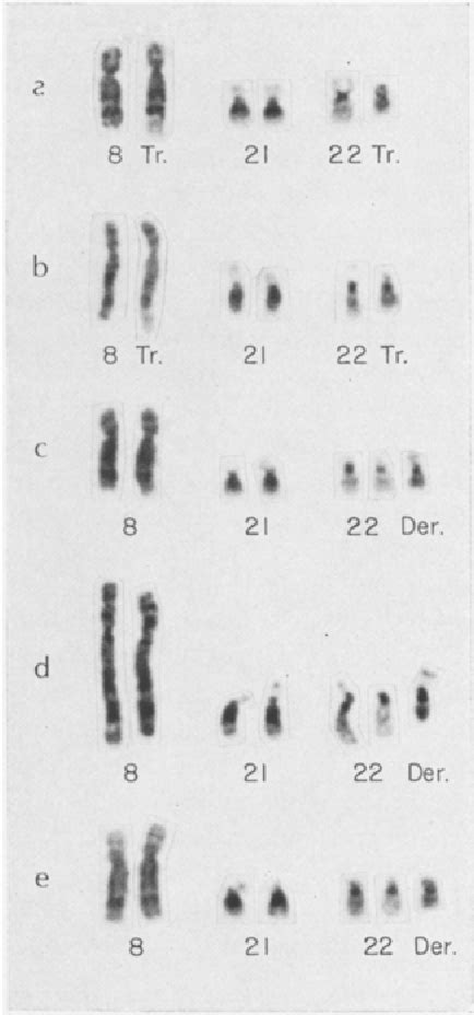 Figure 4 From Partial Trisomy 8 8q24 And The Trisomy 8 Syndrome