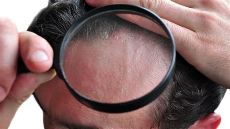 Plaque Psoriasis On Face Pictures Pics Images Mild Symptoms Skin