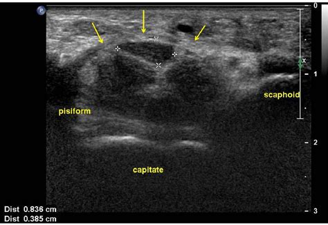 Figure 1 From The Clinical Significance Of Bifid Median Nerve