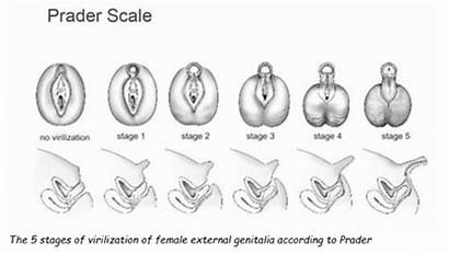 Adrenal Congenital Hyperplasia Newborn Mother Prader Scale