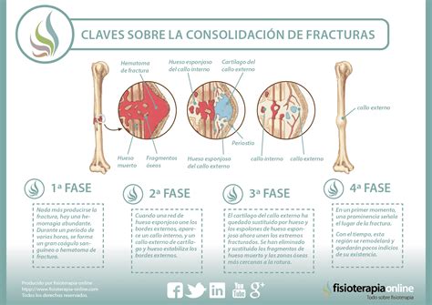 ¿sabes Cómo Se Consolidan O Recuperan Las Fracturas De Huesos Descubre