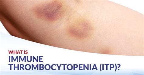 Immune Thrombocytopenia Cfch Centre For Clinical Haematology